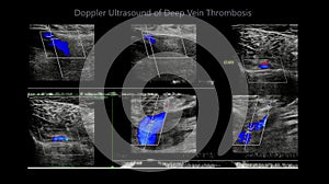 Color Doppler ultrasound determination in deep vein thrombosis patients for finding  deep vein thrombosis of lower extremity