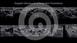 Color Doppler ultrasound determination in deep vein thrombosis patients for finding  deep vein thrombosis of lower extremity