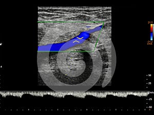 Color Doppler ultrasound determination in deep vein thrombosis patients for finding  deep vein thrombosis of lower extremity