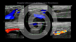 Color Doppler ultrasound determination in deep vein thrombosis patients for finding  deep vein thrombosis of lower extremity