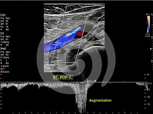 Color Doppler ultrasound determination in deep vein thrombosis patients for finding  deep vein thrombosis of lower extremity