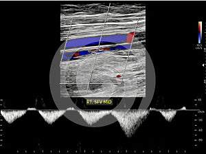 Color Doppler ultrasound determination in deep vein thrombosis patients for finding  deep vein thrombosis of lower extremity