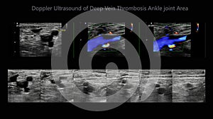 Color Doppler ultrasound determination in deep vein thrombosis patients for finding  deep vein thrombosis of lower extremity