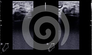 Color Doppler ultrasound determination in deep vein thrombosis patients for finding  deep vein thrombosis of lower extremity