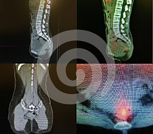 Colorectal carcinoma pet ct diagnostic