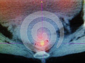 Colorectal carcinoma pet /ct diagnostic