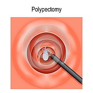 Colorectal polyp and Polypectomy