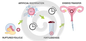 Colored in vitro fertilization IVF flat infographics with steps of additional techniques vector illustration. Ruptured follicle,