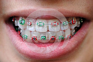 Colorful braces