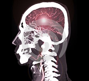 colorful of CT angiography of the brain or CTA brain  sagittal view