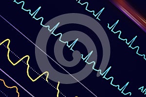 Colorful ECG waves on the monitor