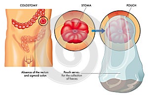 Colostomy photo