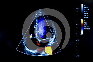Colourful image of homan heart ultrasound monitor