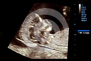 Farebný obraz z tehotenstva ultrazvuk monitorovať 