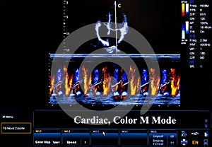 Farebný ultrazvuk monitorovať obraz. srdcovej 
