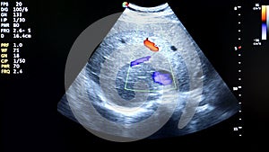 Colourful ultrasound monitor image. Cardiac pulse