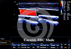 Colourful ultrasound monitor image. Carotid artery