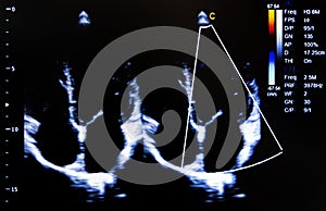 Colourful ultrasound monitor image. Four Chambers View