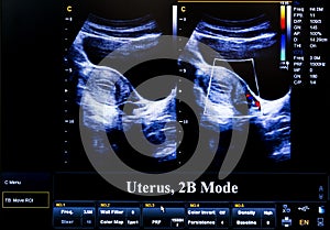 Colourful ultrasound monitor image. Uterus 2D