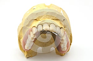 Combined fixed and mobile prosthesis