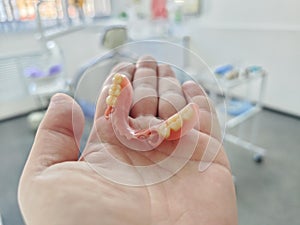 combined removable denture based on acetone and acrylic