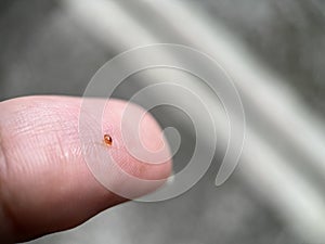 Comedo or blackheads on a finger with blurred background photo