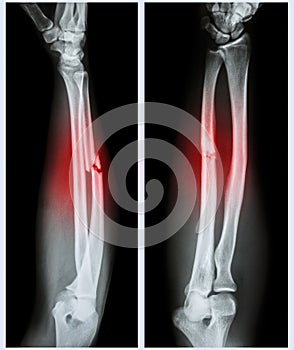 Comminuted fracture shaft of ulnar bone