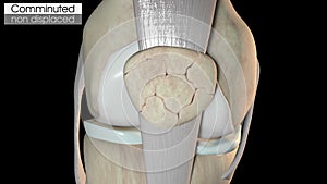 Comminuted non displaced patella fracture overview