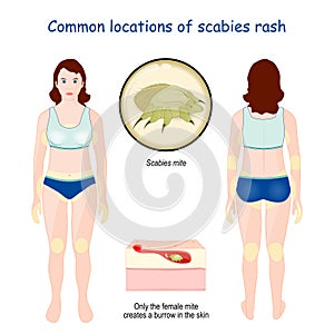 Common locations of scabies rash photo