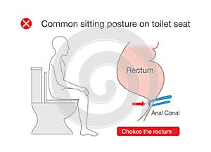 Common posture while sitting on toilet make rectum discomfort. photo