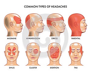 Common types of headaches