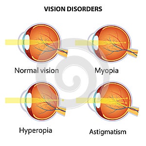 Common vision disorders.
