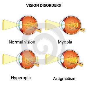 Common vision disorders.