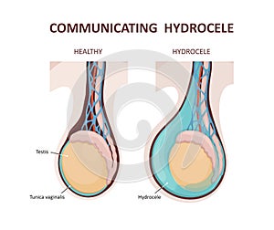 Communicating hydrocele. Testicular disease. photo