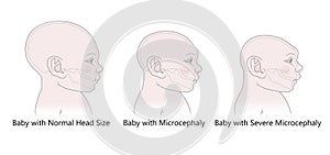 Comparative anatomical image of the head and skull of a newborn child with a normal cranium and with microcephaly and severe