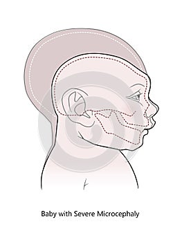 Comparative anatomical image of the head and skull of a newborn child with a normal cranium and with microcephaly and severe