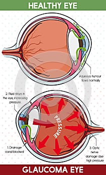 Comparative Information Between Healthy Eye and Glaucoma Eye, Vector Illustration