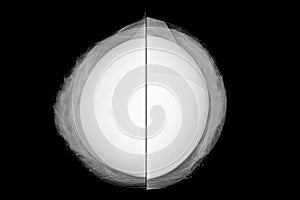 Comparative mammogram in caudal-skull projection