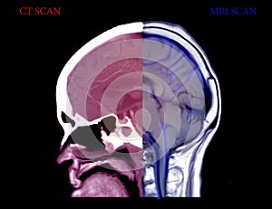 Compare CT Brain and MRI Brain sagittal view .