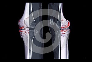 Compare of CT knee joint 3D rendering image and CT knee sagittal view and CT knee 2D Sagittal view isolated on black background