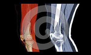 Compare of CT knee joint 3D rendering image lateral view and Sagittal view isolated on black background showing fracture Femur