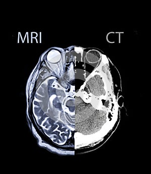 Compare and Mix MRI brain Axial  T2 and Ct brain axial image.