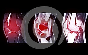 Compare of MRI Knee joint or Magnetic resonance imaging sagital view . photo