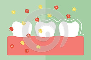 Compare tooth between by protection and not protection bacteria, microbe or virus around teeth - dental cartoon vector flat style