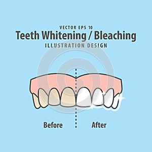 Compare upper teeth Whitening-Bleaching before and after illustration vector on blue background. Dental concept.