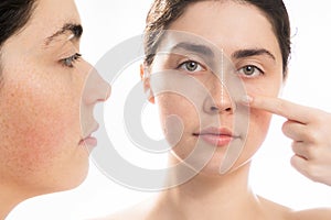 Comparing results before and after plastic nose surgery. Portrait of young caucasian woman point at her straight nose