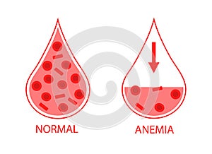 Comparing two drops of blood normal and anemic blood cells. Low hemoglobin. Isolated image on white background photo
