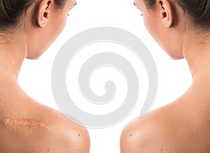 Comparision of female shoulder after scar removing