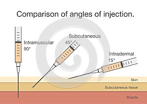 Comparison of the angles of intramuscular injection.