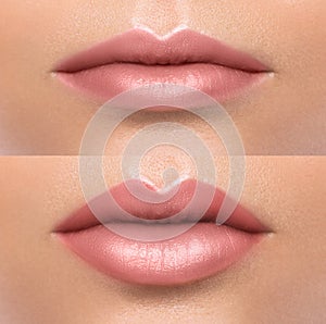 Comparison of beautiful emale lips after augmentation